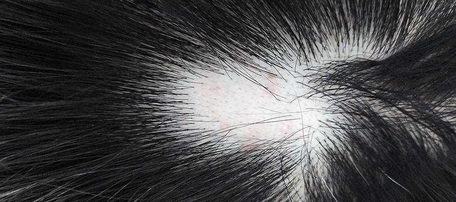 causas de la alopecia areata en mujeres