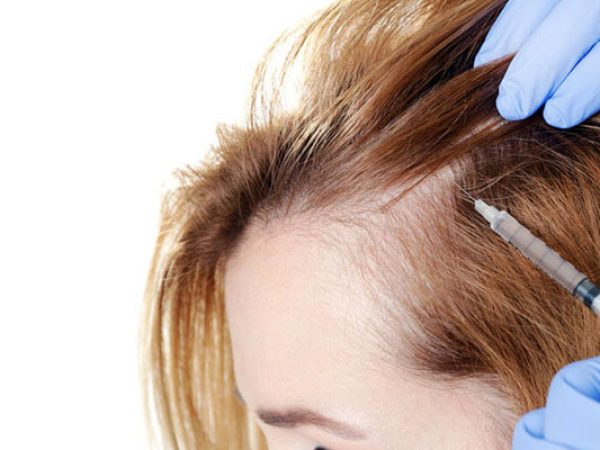 PRP en para combatir la alopecia - ITC Medical