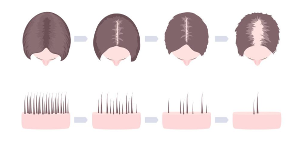 tratamiento para la alopecia androgenica en mujeres
