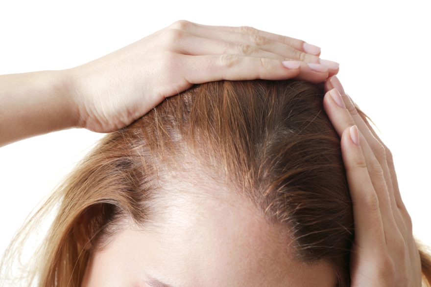 tipos de alopecia en mujeres