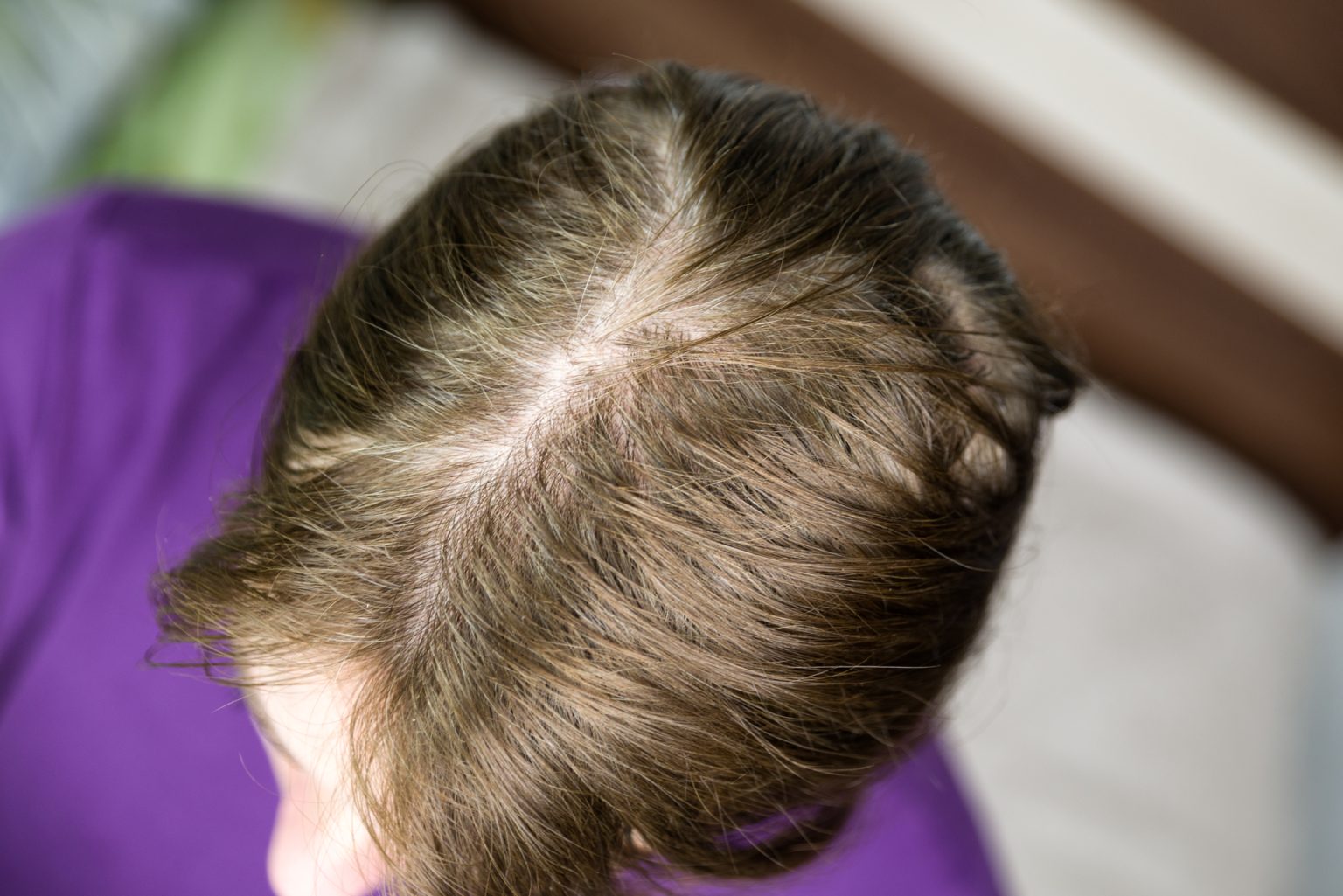 Tipos De Alopecia - ITC Medical