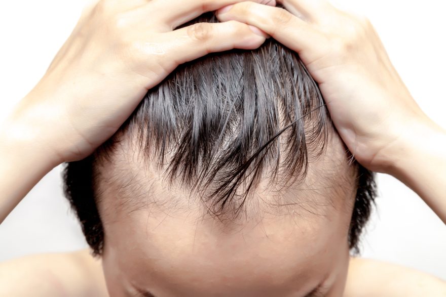 tipos de alopecia masculina