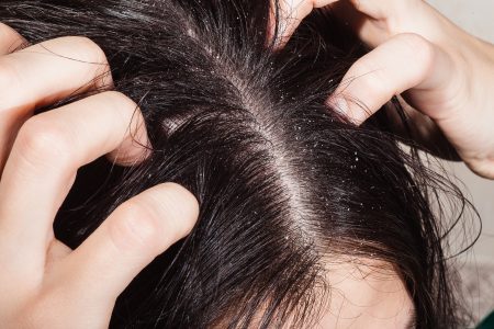dermatitis seborreica cuero cabelludo