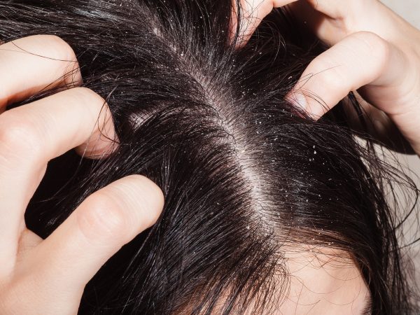 Cita Pasto tarjeta Cómo afecta la dermatitis seborreica al pelo y cuero cabelludo? - ITC  Medical