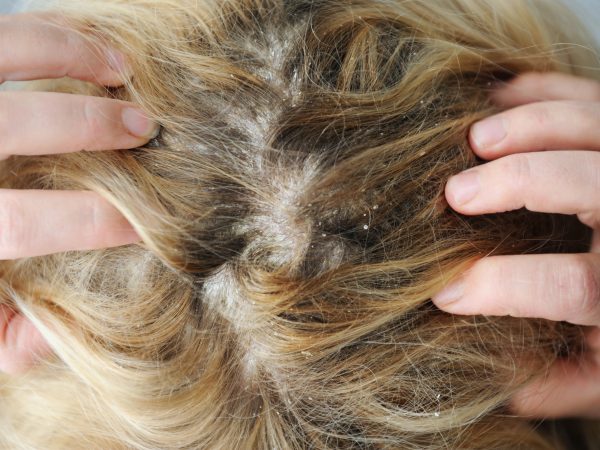Ya honor Íntimo Qué relación hay entre el pelo graso y la caída del cabello? - ITC Medical