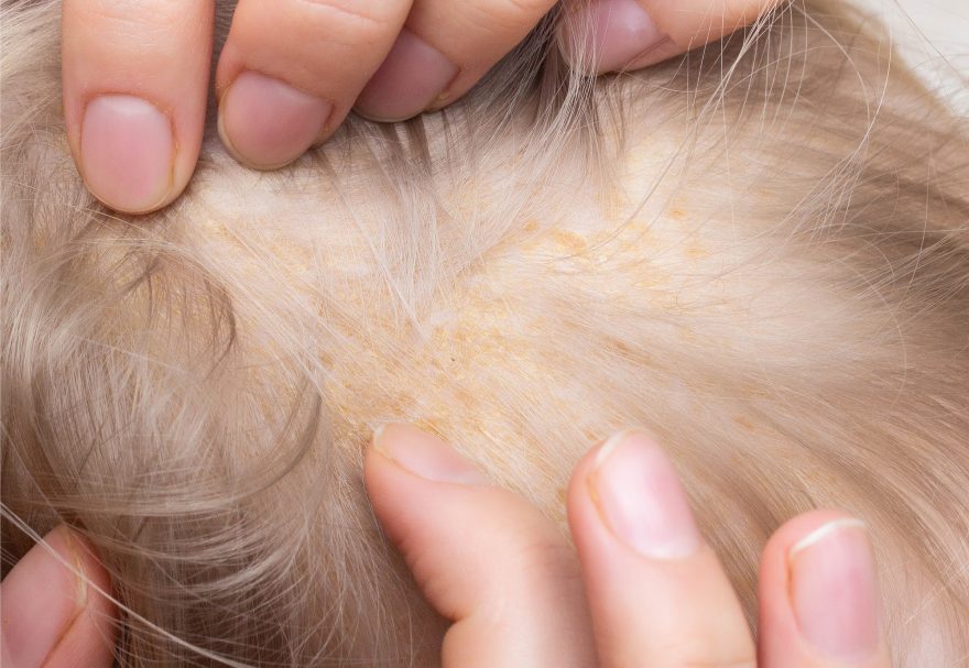 Ligero Apretar Incorrecto Enfermedades del cuero cabelludo - ITC Medical