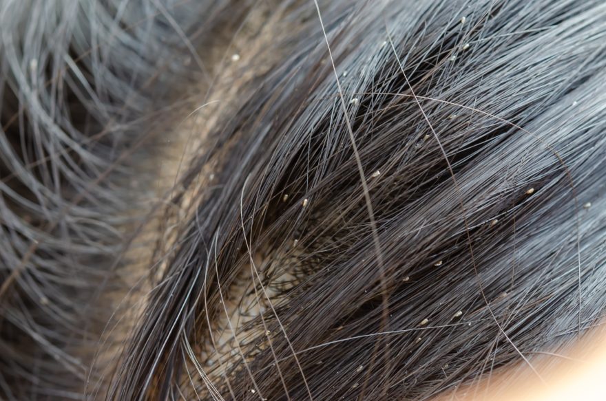 enfermedades del cuero cabelludo pediculosis
