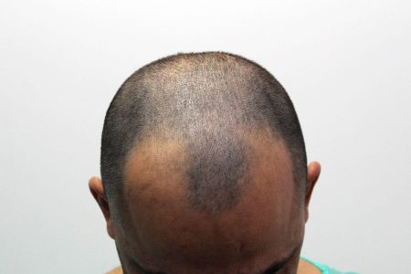 a que edad se estabiliza la alopecia androgenetica