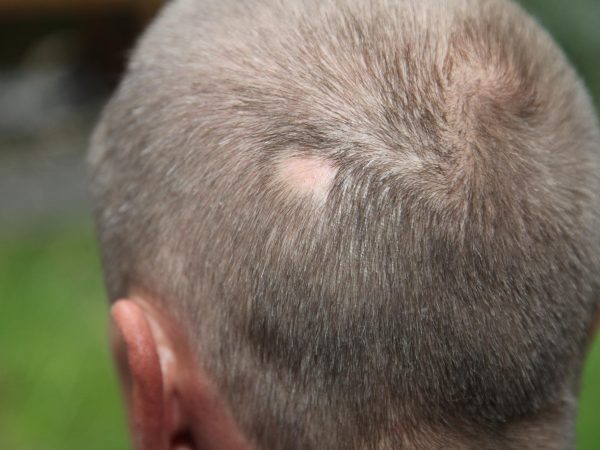 Recientemente rango A menudo hablado Todo sobre la alopecia areata - ITC Medical