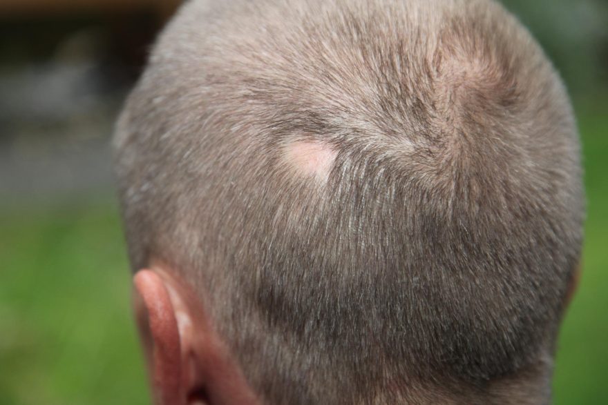 Todo sobre la alopecia areata Medical