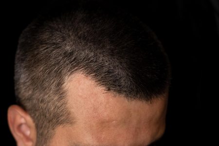 alopecia androgenetica