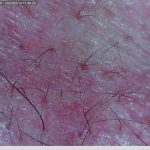 alopecia androgenética