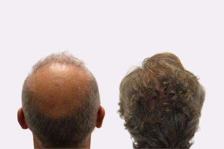 zona donante injerto capilar